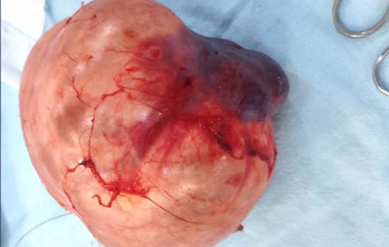 A lump weighing one and a half kg was removed from the kidney
